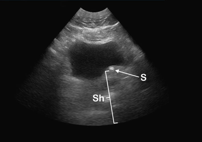 Kidney Stones Ultrasound