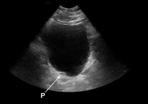 Figure 2 Emergency department ultrasound (EDUS). A pseudoureterocele (P) showing characteristic cystic appearance at the right posterior bladder wall.