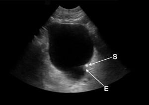Figure 3 Emergency department ultrasound (EDUS). Direct stone visualization (S) with edema (E) and possible ureteric prolapse (P) at the left posterior bladder wall.