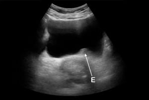 Figure 4 Emergency department ultrasound (EDUS). Inward protrusion from edema (E) without stone visualization at the left posterior bladder wall.