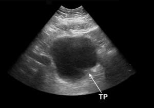 Figure 5a Emergency department ultrasound (EDUS). Thickening (T) and inward protrusion (P) at the left posterior bladder wall.