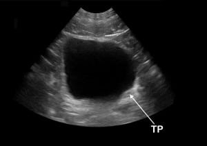 Figure 6 Emergency department ultrasound (EDUS). Thickening (T) and inward protrusion (P) of the left posterior bladder wall.
