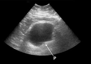 Figure 7a Emergency department ultrasound (EDUS). Inward protrusion (P) of the left posterior bladder wall.