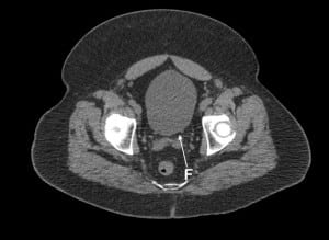 Figure 7b Computed tomography (CT) of the abdomen and pelvis (CT KUB). Flattening (F) of the left posterior bladder wall.