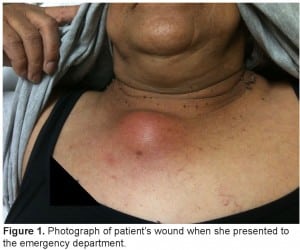 Figure 1. Photograph of patient’s wound when she presented to the emergency department.