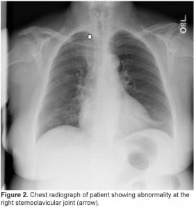Figure 2. Chest radiograph of patient showing abnormality at the right sternoclavicular joint (arrow).