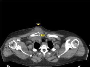 Figure 3. Non-contrast computed tomography of chest showing erosion of the right medial clavicle (arrow) with overlying soft tissue swelling (arrow head).