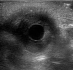 Figure. B-mode view of pupil without light administration (left). B-mode view of pupil during light administration (right).