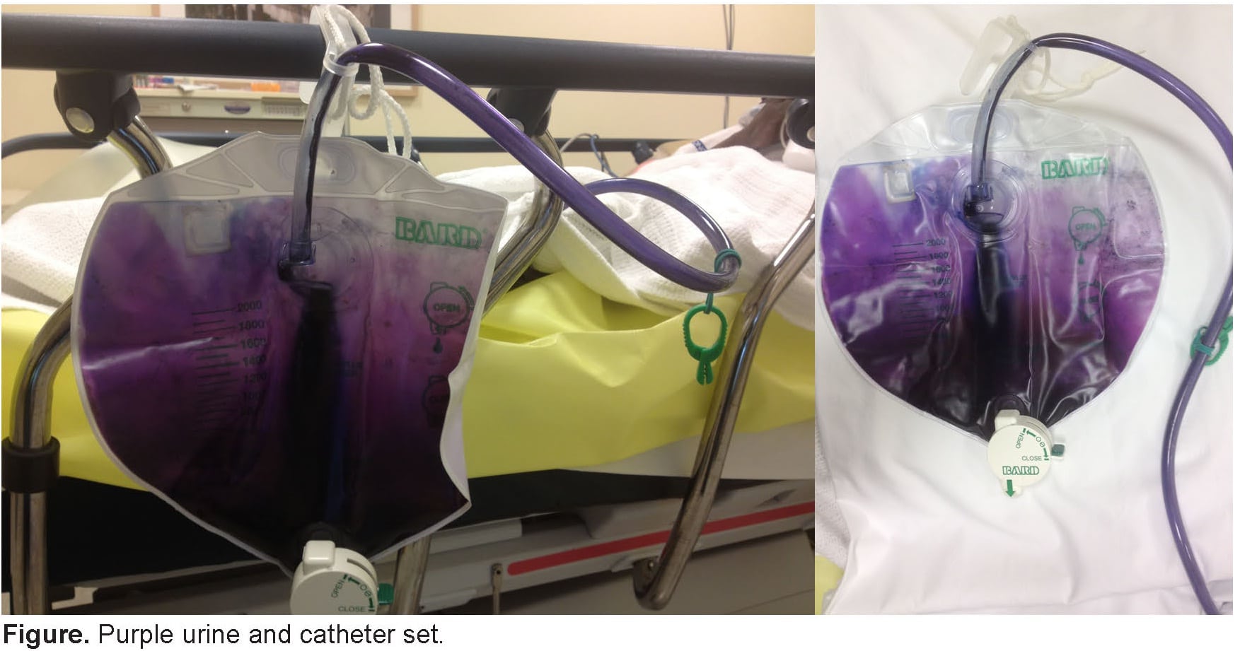 Purple Urine Bag Syndrome