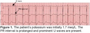 Figure 1. The patient’s potassium was initially 1.7 meq/L. The PR interval is prolonged and prominent U waves are present.