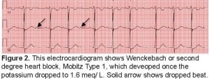Figure 2. This electrocardiogram shows Wenckebach or second degree heart block, Mobitz Type 1, which deveoped once the potassium dropped to 1.6 meq/ L. Solid arrow shows dropped beat.
