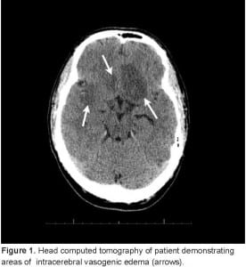 Figure 1. Head computed tomography of patient demonstrating areas of intracerebral vasogenic edema (arrows).