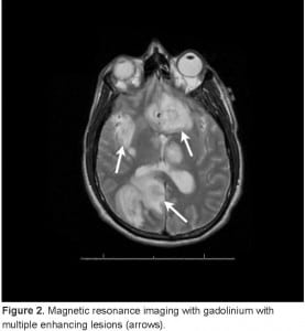 Figure 2. Magnetic resonance imaging with gadolinium with multiple enhancing lesions (arrows).