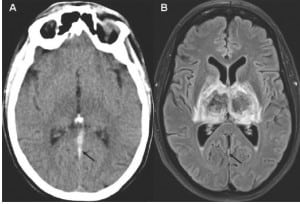 Figure A. Unenhanced brain computed tomography. Strong hyperintensity within straight sinus due to the presence of an acute clot (arrow) together with subtle hypo-intensity within both thalamomesencephalic junctions. B. Magnetic resonance imaging with Fluid Attenuated Inversion Recovery (FLAIR) sequence. Hemorrhage within both thalami (central hyposignal intensity due to the presence of deoxyhemoglobin and marginal hyper signal intensity due to surrounding vasogenic edema). Thin residual clot within straight sinus (arrow) and moderate enlargement of lateral ventricles.