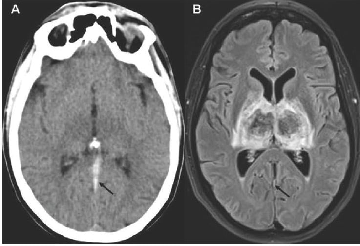 Bilateral Thalamic Infarction