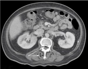 Figure. The air in the right paraspinous musculature and spinal column seen on the computed tomography are the first evidence of the lumbar spinal epidural abscess.