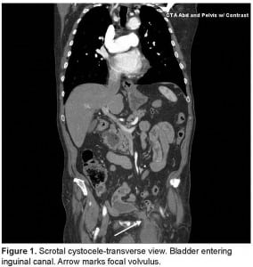 Figure 1. Scrotal cystocele-transverse view. Bladder entering inguinal canal. Arrow marks focal volvulus.