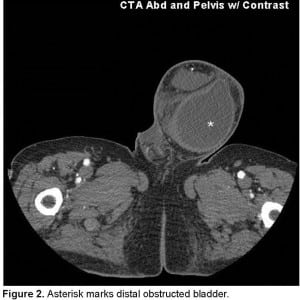 Figure 2. Asterisk marks distal obstructed bladder.