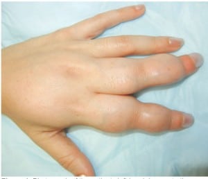 Figure 1: Photograph of the patients left hand demonstrating marked deformity and apparent swelling of the 2nd and 3rd digits and metacarpal bones.