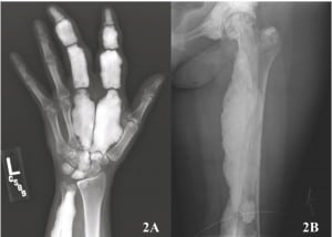 Figure 2: (A) Radiograph of the left hand showing dense sclerosis, lengthening, and expansion of the second and third phalanges and metacarpals with increased density of the lunate, capitate, and trapezoid and, (B) radiograph of the left proximal femur showing diffuse dense cortical thickening with characteristic “flowing candle wax” appearance.