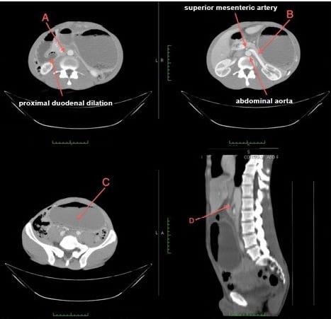 An Uncommon Case of Abdominal Pain: Superior Mesenteric Artery Syndrome