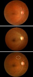 Figure 1 Normal versus grade I/II hypertensive retinopathy. (Top) Normal ocular fundus. Note that the ratio between the arteries and the veins (arteriovenous [AV] ratio) is about 2:3. (Middle) Grade I hypertensive retinopathy. Note mild narrowing and sclerosis of retinal arteries with an overall AV ratio of about 1:2. (Bottom) Grade II hypertensive retinopathy. There is AV nicking (arrow) and moderate to severe narrowing and sclerosis of arterioles (eg, within the ellipse the AV ratio is less than 1:2).