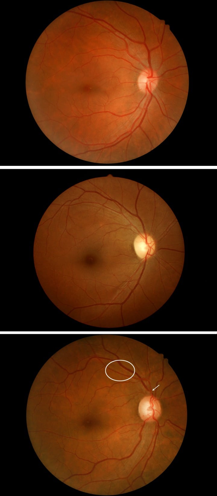 Grade III or Grade IV Hypertensive Retinopathy with Severely Elevated Blood Pressure