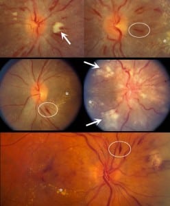 Figure 2 Examples of grade III/IV hypertensive retinopathy. Note the features of grade III retinopathy: exudates (asterisks), cotton wool spots (arrows), and nerve fiber layer hemorrhages (ellipses). Grade IV hypertensive retinopathy is defined by the presence of features of grade III retinopathy plus optic nerve head edema (eg, the middle right panel).
