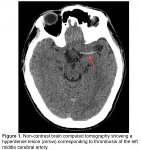 Figure 1. Non-contrast brain computed tomography showing a hyperdense lesion (arrow) corresponding to thrombosis of the left middle cerebral artery.