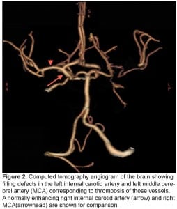 Figure 2, Computed tomography angiogram of the brain showing filling defects in the left internal carotid artery and left middle cerebral artery (MCA) corresponding to thrombosis of those vessels. A normally enhancing right internal carotid artery (arrow) and right MCA(arrowhead) are shown for comparison.