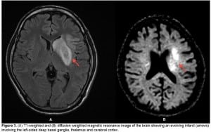 Figure 3. (A) T1-weighted and (B) diffusion weighted magnetic resonance image of the brain showing an evolving infarct (arrows) involving the left-sided deep basal ganglia, thalamus and cerebral cortex.