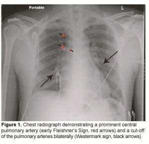Figure 1. Chest radiograph demonstrating a prominent central pulmonary artery (early Fleishner’s Sign, red arrows) and a cut-off of the pulmonary arteries bilaterally (Westermark sign, black arrows).