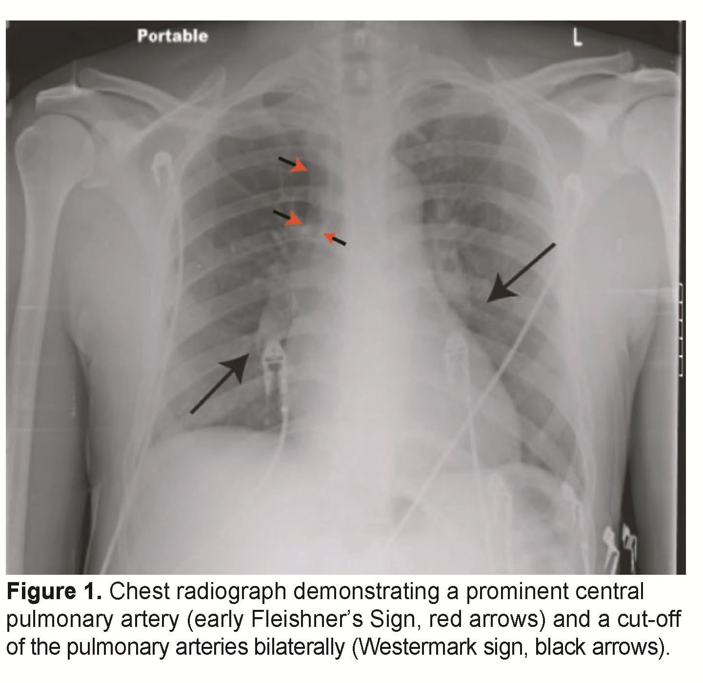 Persistent Hiccups as a Rare Presenting Symptom of Pulmonary Embolism