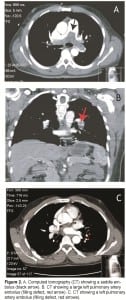 Figure 2. A. Computed tomography (CT) showing a saddle embolus (black arrow). B. CT showing a large left pulmonary artery embolus (filling defect, red arrow). C. CT showing a left pulmonary artery embolus (filling defect, red arrows).