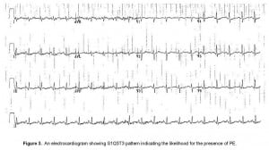 Figure 3. An electrocardiogram showing S1Q3T3 pattern indicating the likelihood for the presence of PE.