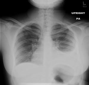 Figure 1 Chest x-ray demonstrating a left-sided pleural effusion.