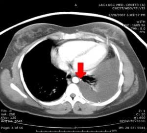 Figure 2 Computed tomography chest demonstrating the tip of the ventriculo-peritoneal shunt catheter adjacent to the aorta.