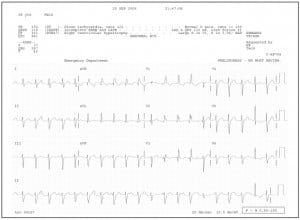 Figure 2. Lead II rhythm strip from a 12-lead ECG demonstrating AV dissociation in a patient with confirmed VT. Note that P waves march out independent of the QRS complexes, best seen in beats 2–10. Some of these P waves fall within or before the T wave, modifying its appearance. Also identified in lead II arefusion beats (QRS complexes #11, 15, and 20), and a narrow complex capture beat (next to last QRS complex #19).