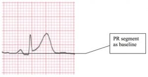 Figure 2 The ECG Baseline