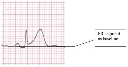 EKG Criteria for Fibrinolysis: What’s Up with the J Point?