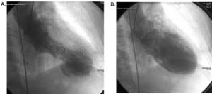 Figure 1 Cardiac catheterization demonstrating the patient’s left ventricular severe anterior-apical akinesis with compensatory inferior-posterior hyperkinesis during systole (A) and diastole (B).