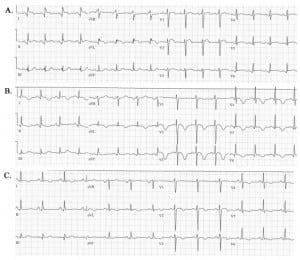 Figure 2 Electrocardiograms of patient showing (A) ST-segment elevation is leads V1–V3, I and aVL at 15 minutes after presentation, (B) T-wave inversion in leads V2–V6, I and aVL and a lengthened QT at one day after presentation, and (C) improvement of the T-wave inversion and normalization of ST-elevation at four days after presentation.