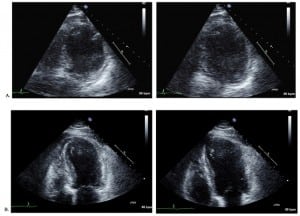 Figure 3 Transthoracsic echocardiogram showing (A), on day one, a severely hypokinetic left ventricular anteroapical wall and mid to distal septum during systole (left) and diastole (right) and (B) on day four, some minor improvements to the wall motion abnormalities during systole (left) and diastole (right).
