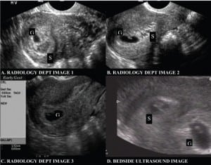 Figure 1 Endovaginal ultrasound with one live intrauterine pregnancy and a separate subchorionic hemorrhage resembling two gestational sacs. (S= subchorionic hemorrhage; G= gestational sac)