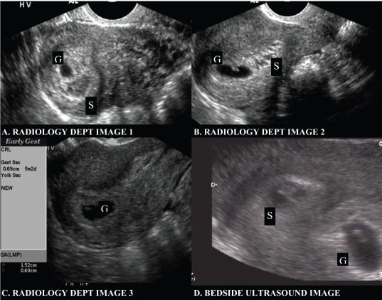 Subchorionic Hemorrhage Appearing as Twin Gestation on Endovaginal Ultrasound