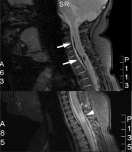 Figure 1 Upper plate, T1-weighted image showing anterior subdural hemorrhage from C2 to C7 (arrows). Lower plate, T2-weighted image showing extensive cord hemorrhage between C7 and T1.