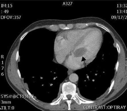 Left Atrial Myxoma