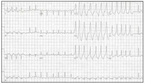 Figure 1.  ECG representing Wolff-Parkinson-White Syndrome (WPWS) with Atrial Fibrillation (AFIB). Note the wide QRS complexes, and the irregularly irregular rhythm. In lead II, the axis changes. A slurred delta wave can be identified in the left precordial leads, since the overall rate is not as fast as it might be when these conditions coexist. The R-R interval of the first two QRS complexes seen in leads V1–3 approaches 300, which is extremely dangerous.