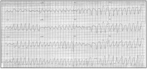 Torsade de pointes (polymorphic VT) captured on 12-lead ECG. The baseline literally “twists of the points.” Treatment is with intravenous magnesium, and possibly overdrive pacing 