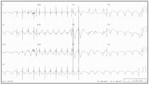 Figure 3 Permanent transvenous pacemaker results in wide QRS complexes.